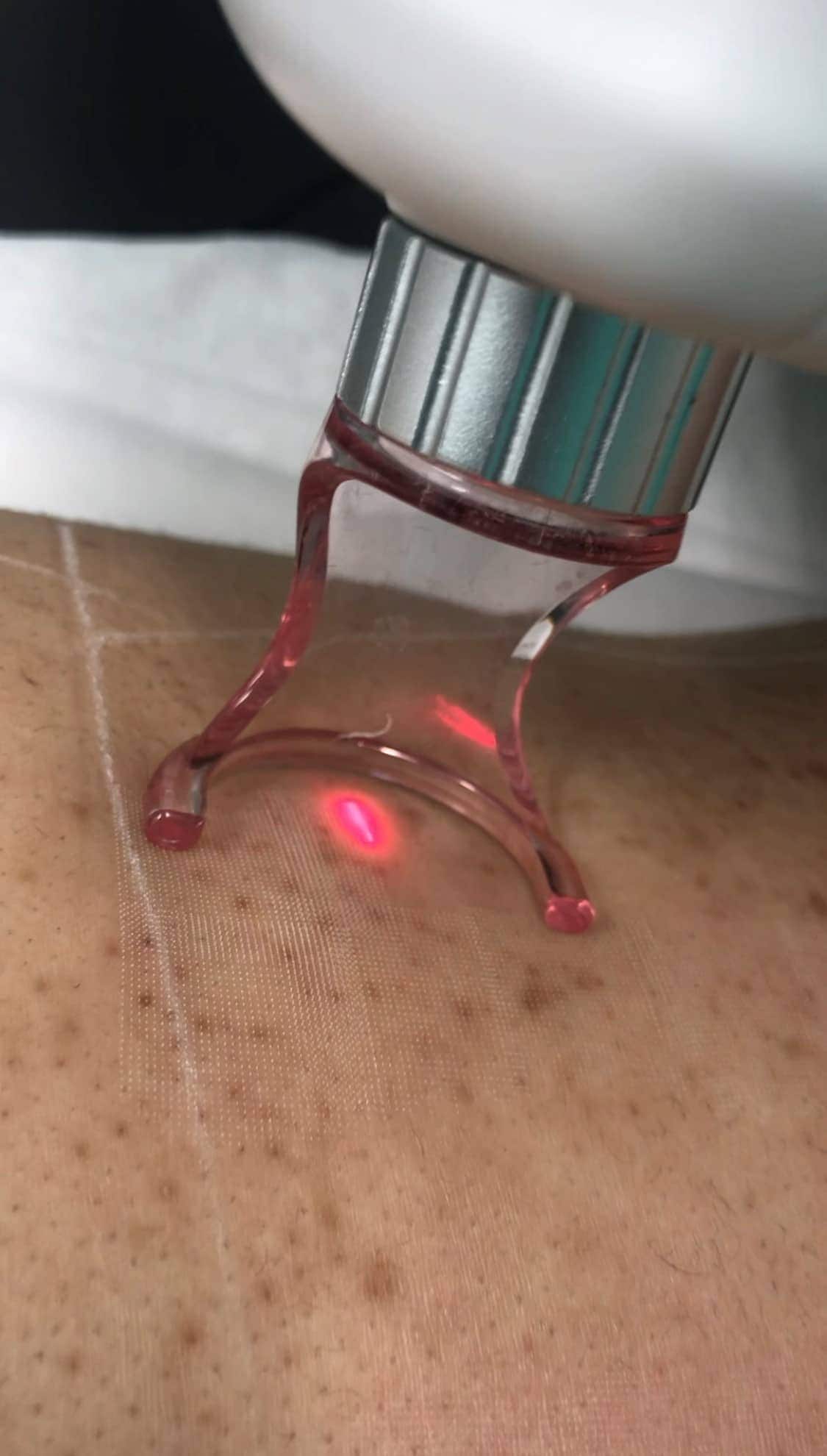 CO2 laser treatment