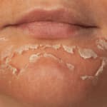 The Perfect Derma Peel