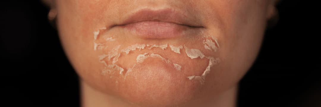 The Perfect Derma Peel