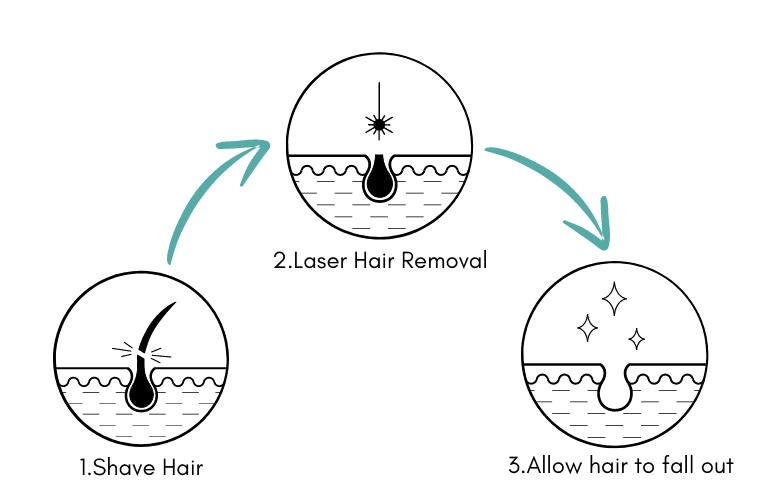 The Laser Hair Removal Process